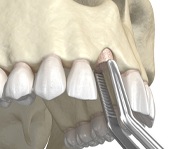 diagram of a bone graft for dental implants in Alexandria