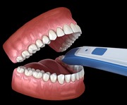 diagram of using digital impressions system