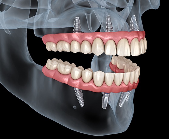 Illustration of All-on-4 dentures