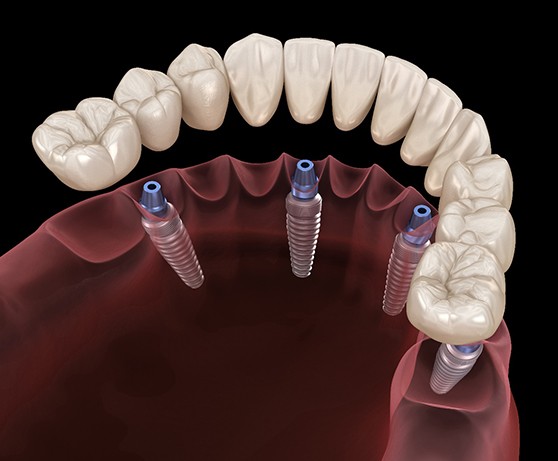 Illustration of dentures being attached to All-on-4 implants