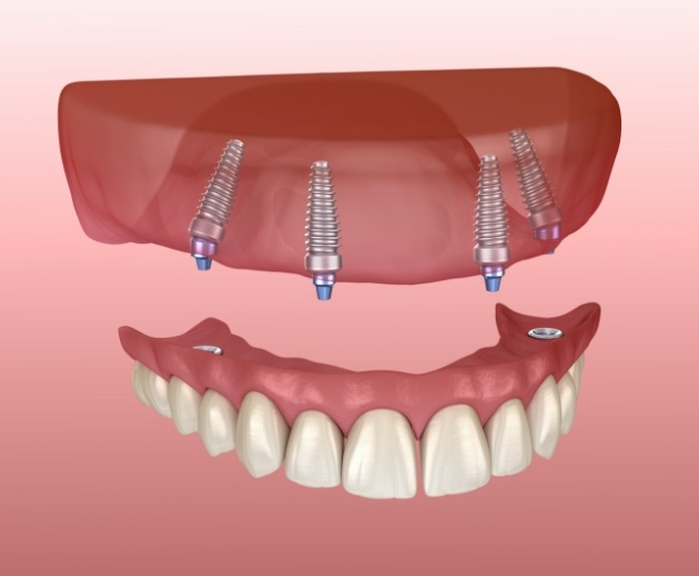 Animated smile during All on four dental implant denture placement