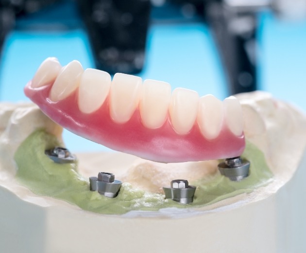 Model all on four dental implant denture