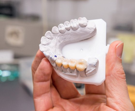 A customized dental bridge in Alexandria 