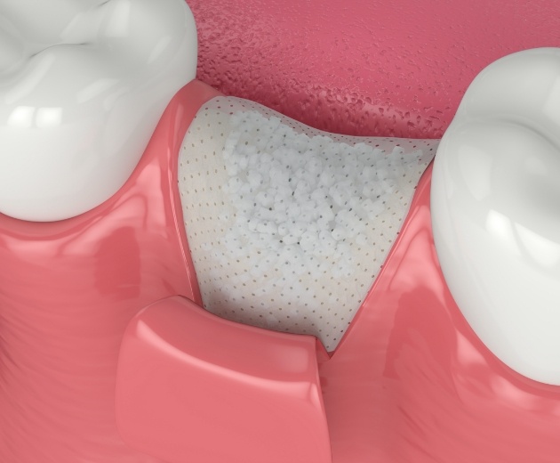 Animated smile after bone grafting