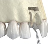 Animated smile during autogenous bone grafting treatment