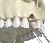 Animated smile during allogenic bone grafting treatment