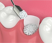 Animated smile during synthetic bone grafting treatment