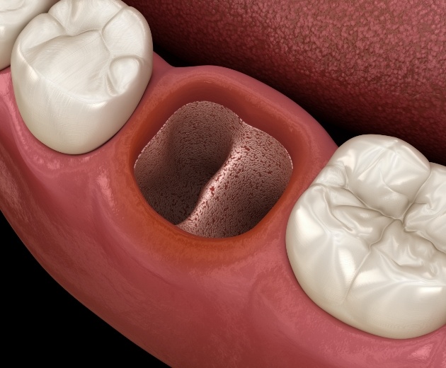 Animated smile with empty socket after tooth extraction