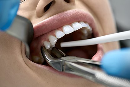 There are many factors that affect the cost of tooth extraction