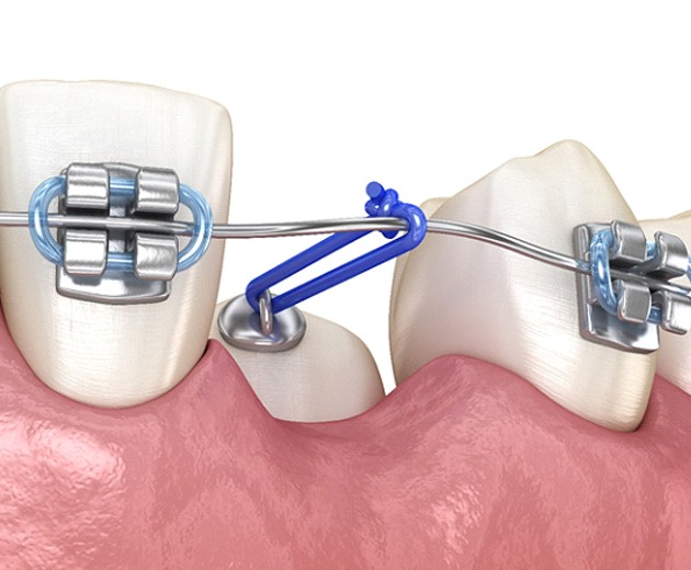 Illustration of special bracket being used to treat impacted canine