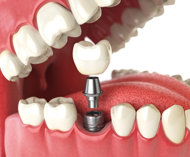 Crown, abutment, and dental implant going into the lower jaw