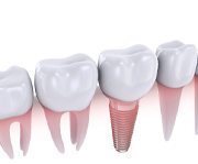 3D illustration of a dental implant in lower jaw