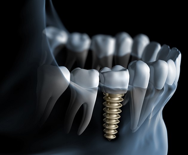 Digital illustration of dental implant