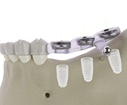 Illustration of surgical guide for dental implants