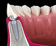 Diagram showing how dental implants in Alexandria fuse with jawbone