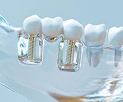Implant bridge attached to a transparent dental model