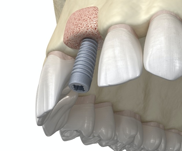 Animated smile after surgical dental implant placement