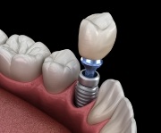 Animated smile during dental implant supported dental crown placement