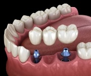 Animated smile during dental implant supported fixed bridge placement