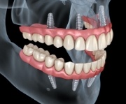 Animated smile after dental implant supported denture placement