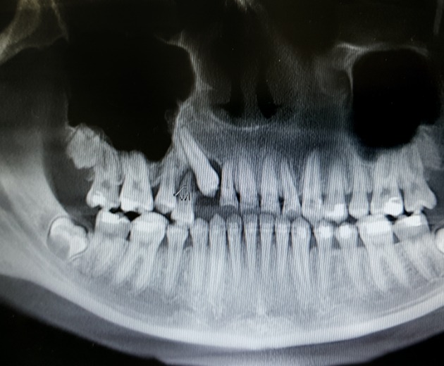 X-ray of smile with impacted canine