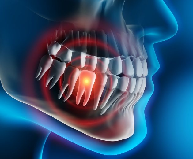 3 D rendering of smile with damaged tooth in need of extractions