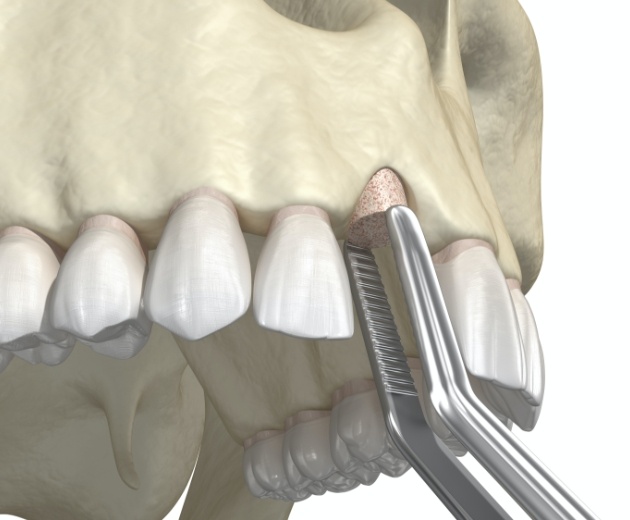 Animated smile after bone grafting