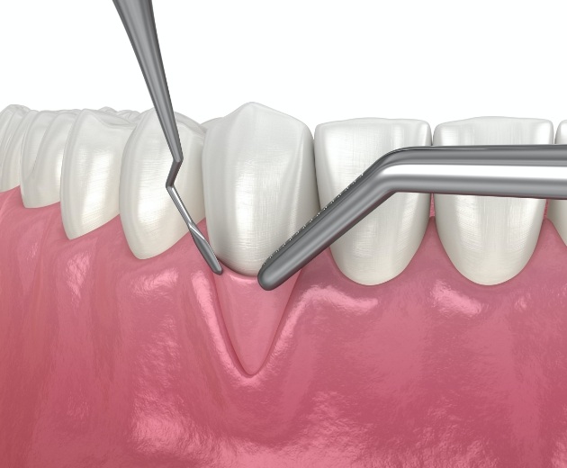 Animated smile during soft tissue augmentation treatment