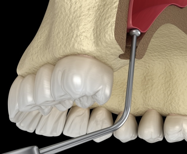 Animated smile during sinus lift procedure