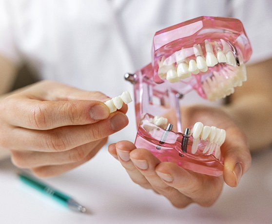 a model of an implant bridge