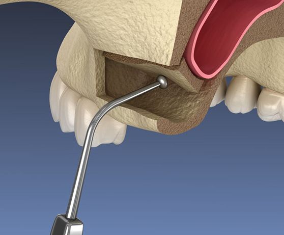 Digital illustration of sinus lift procedure