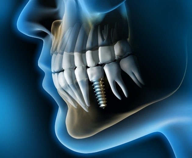 Animated facial profile with dental implant supported dental crown