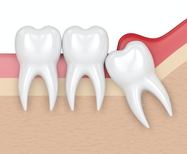 Animated smile with impacted wisdom tooth