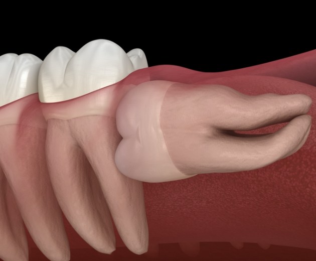 Animated row of teeth with impacted wisdom tooth