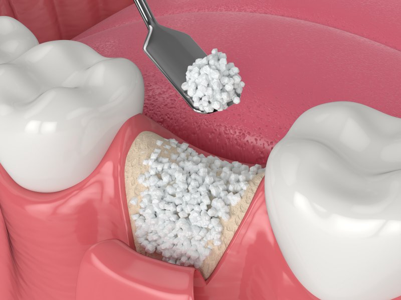 Diagram showing how a dental bone graft works