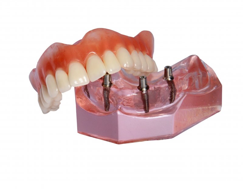 All-on-4 dentures designed for full mouth reconstruction in Alexandria