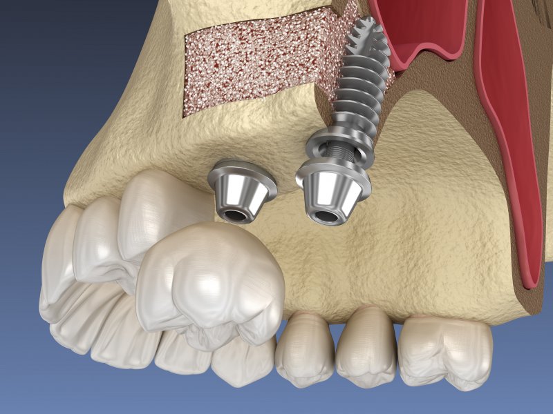 Dental implants after a sinus lift