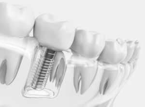 Dental implant in plastic tray with model teeth