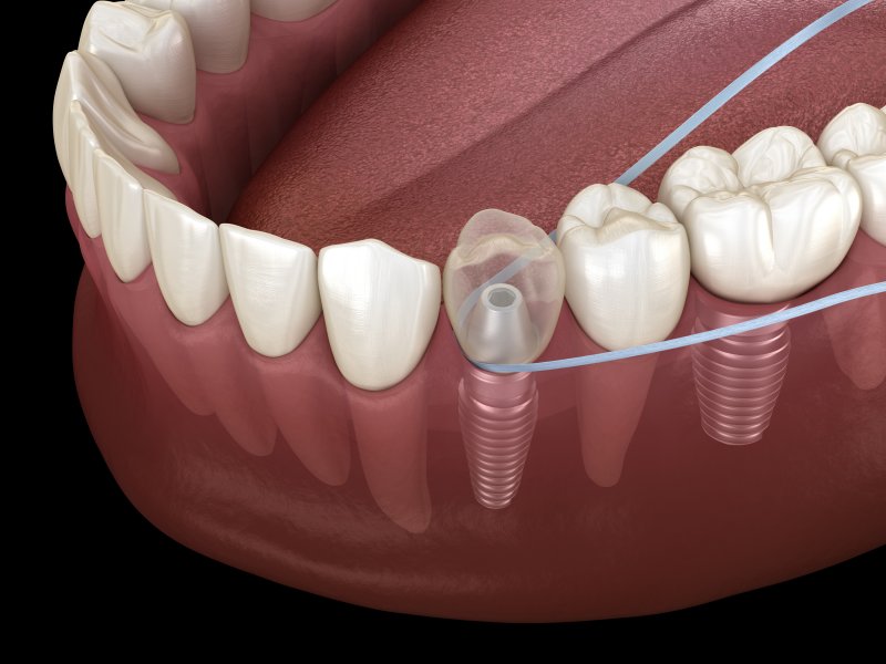 3-D diagram of floss around a dental implant