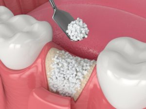 closeup diagram of a bone graft