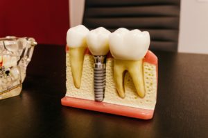 Model of a dental implant for tooth loss