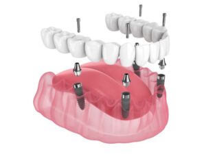 Animated model of All-on-4 dental implants.