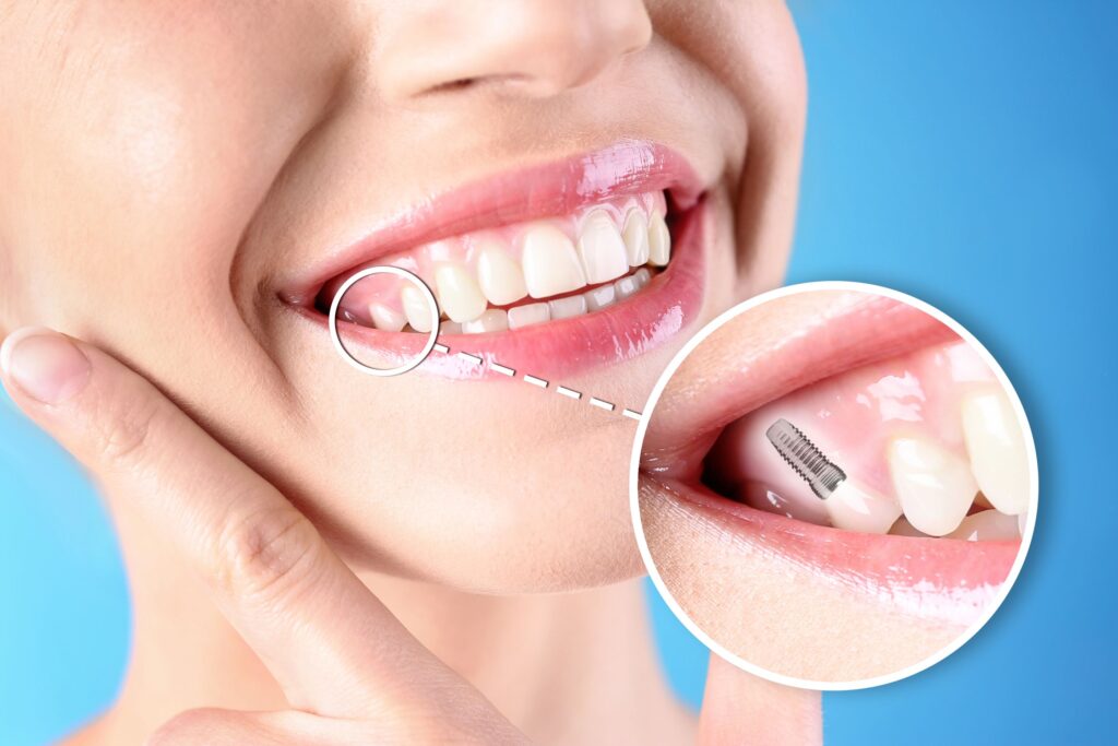 Nose-to-neck view of woman smiling with a tooth indicated as an implant