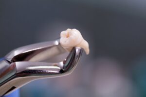 Dentist holding a wisdom tooth with forceps