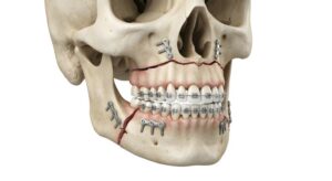 Illustration of human skull after corrective jaw surgery 