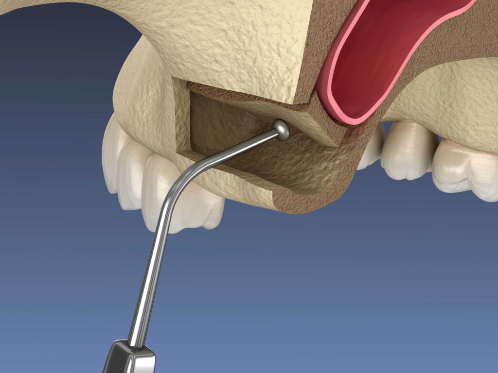 Illustration of a sinus lift